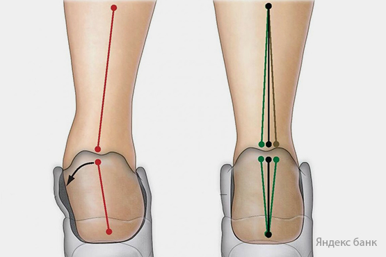 Пронация стопы